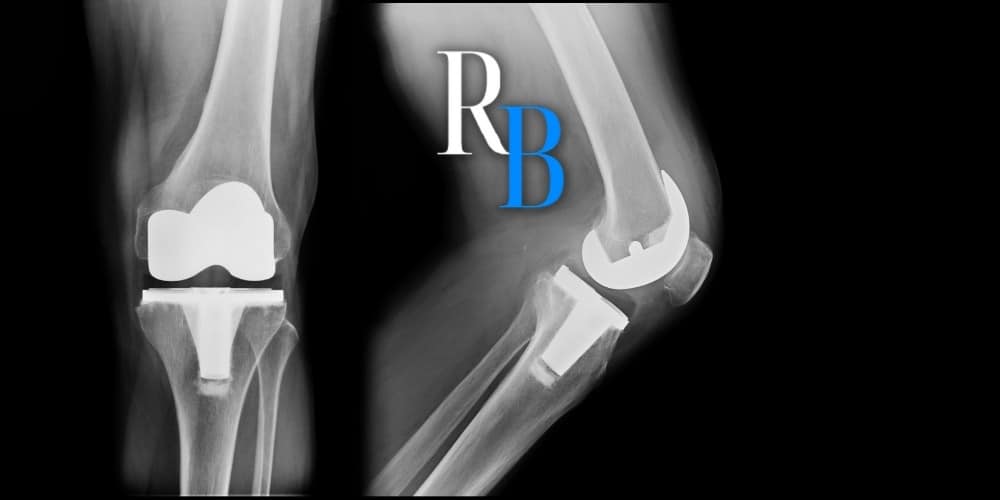 How do I know if I Have a Defective Exactech Knee Replacement?